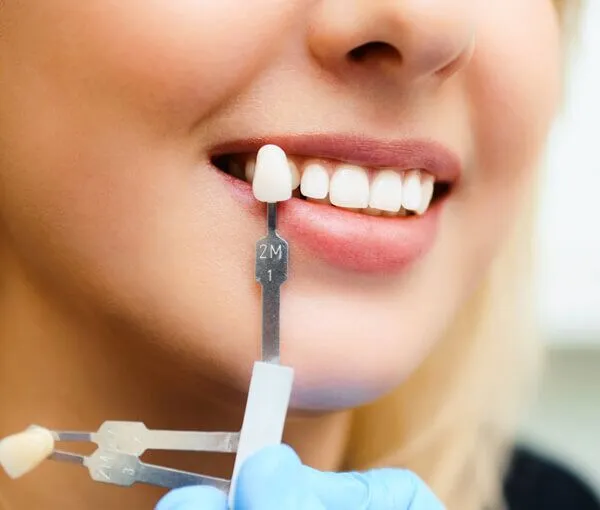 Are There Any Special Precautions for Jaw-Grinders Getting Laser Whitening Abingdon