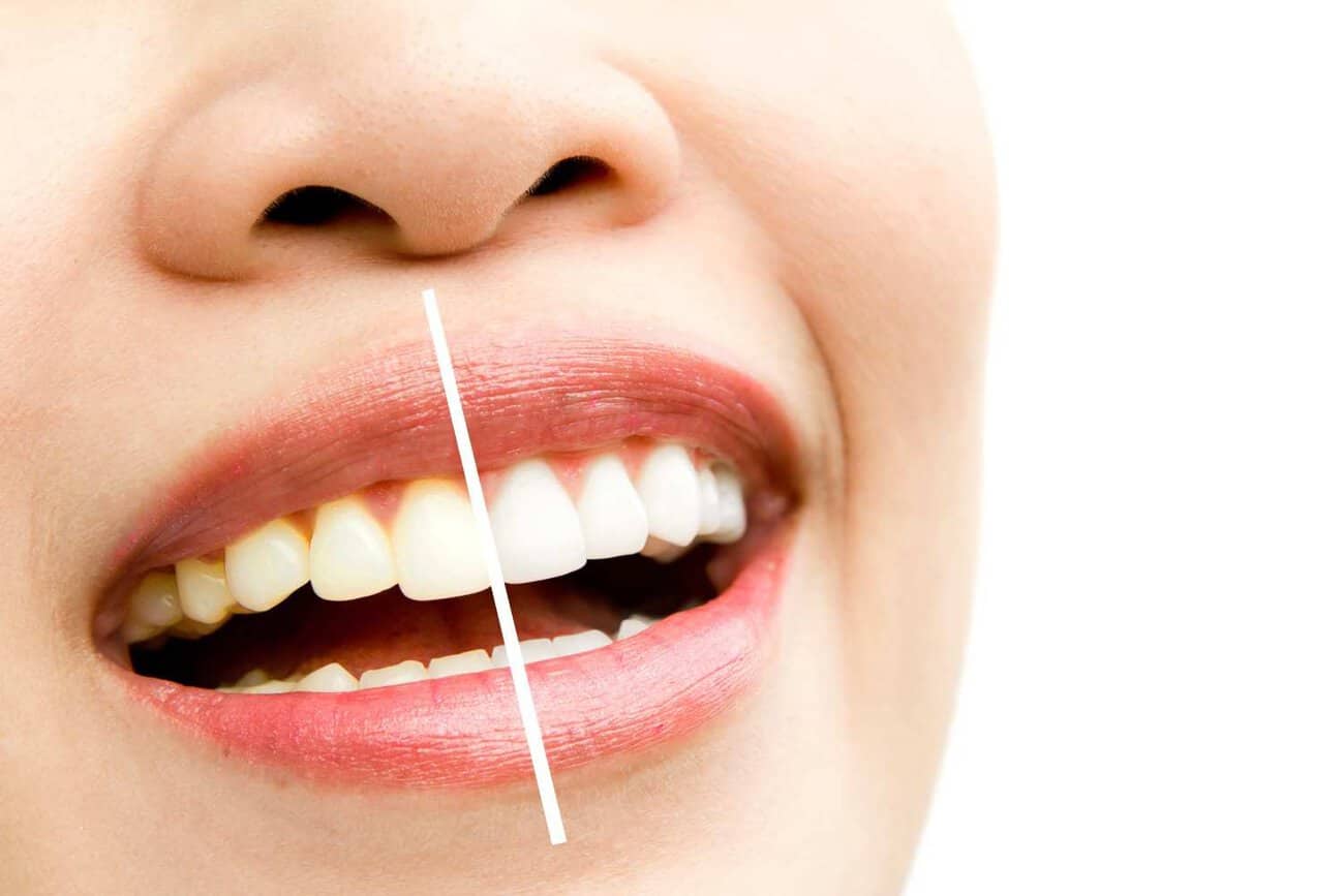 Why Do Some People Experience Sensitivity After Laser Teeth Whitening Abingdon
